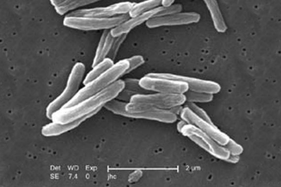 tuberculosis_madras_courier
