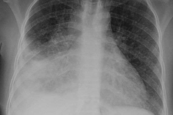 tuberculosis_tb_madras_courier