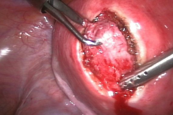 hysterectomy_madras-courier