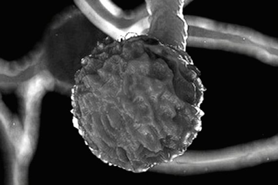 black_fungus_madras_courier