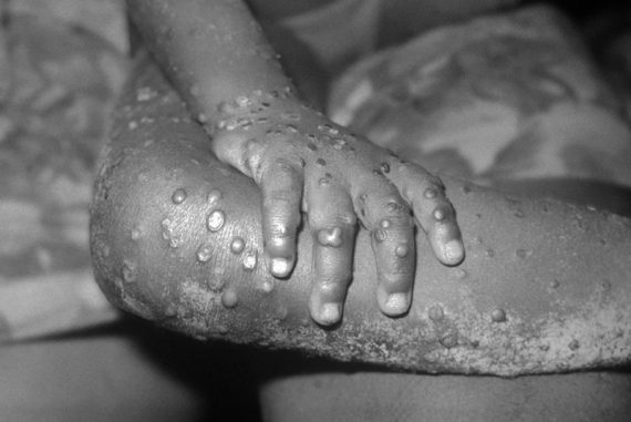 monkeypox_madras_courier