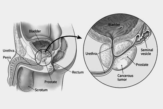 prostate_cancer_madras_courier