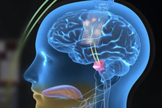 neuroprosthesis-madras-courier