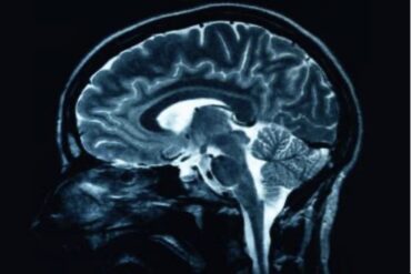 Brain-Tumour-Madras-Courier